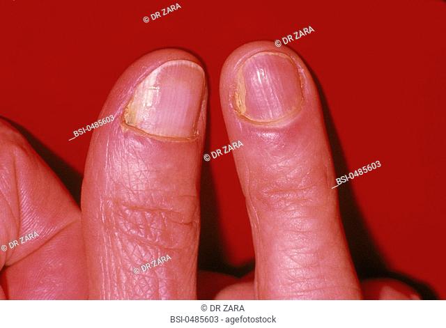 MYCOSIS<BR>Fungal nail infection caused by Candida albicans
