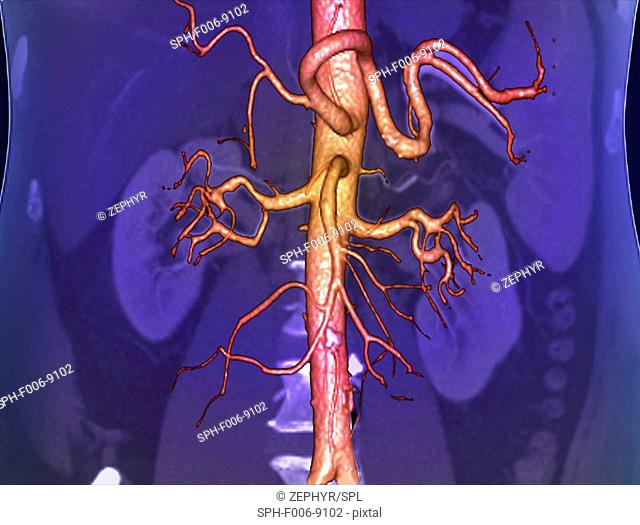 Abdominal aorta. Coloured 3D computed tomography (CT) angiogram of the abdominal aorta of a 53 year old patient. The aorta is the body's main artery
