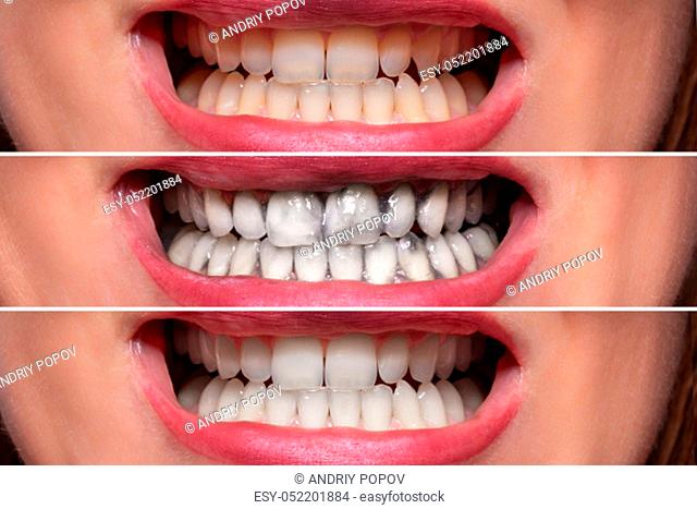 Close-up Detail Of Smiling Woman Teeth Before And After Cleaning With Charcoal Toothpaste
