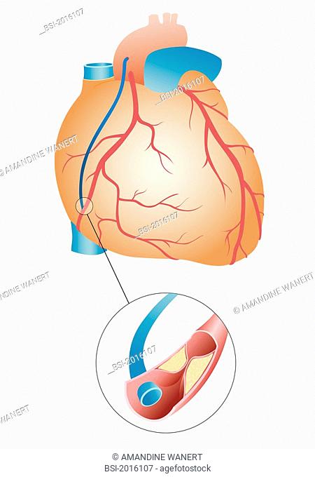 BY-PASS, ILLUSTRATION Aortocoronary bypass following a myocardial infarction. The obstruction of a coronary vessel by a plaque of atheroma is compensated by the...
