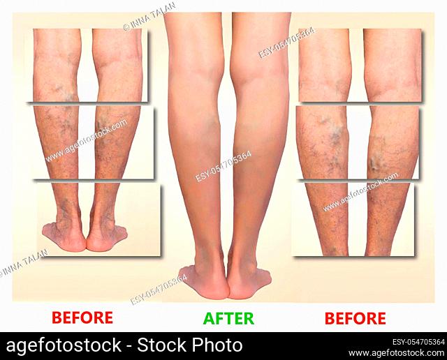 Treatment of varicose before and after. Varicose veins on the senior female legs. Before after concept