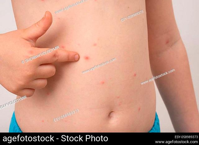 Baby with chicken pox rash. Varicella virus or Chickenpox bubble rash on child. Dermatology concept. Toddler shows blemishes on his belly