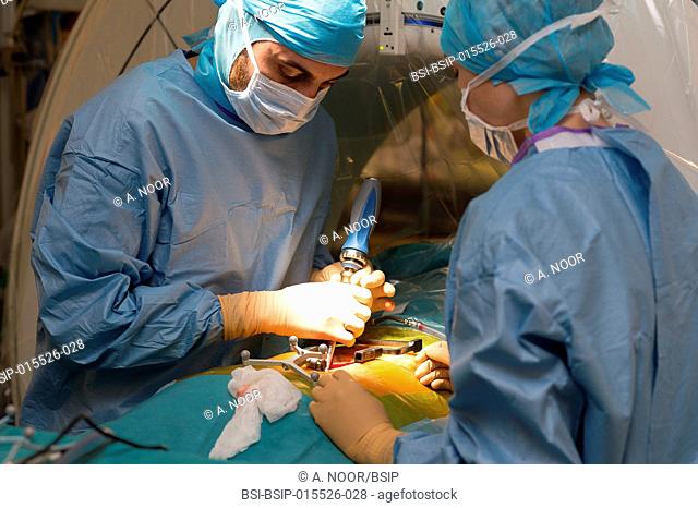 Reportage in the orthopedic surgery operating theatre in Pasteur 2 Hospital, Nice, France. Medullary liberation and arthrodesis in a patient suffering from...