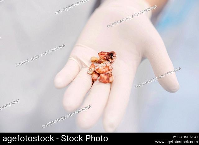 Extracted teeth in dentist's hand