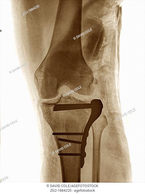 Operation to repair a fractured knee joint see also x-ray images of plates screws and pins No MR needed - photographer's own leg !