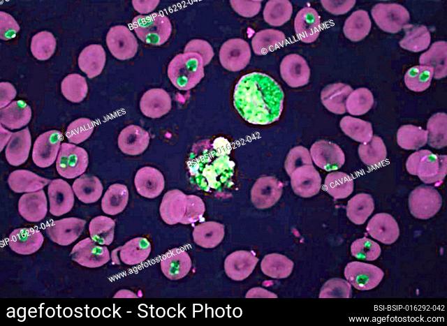 Plasmodium falciparum is a malaria-causing parasite or malaria, transmitted by the bite of female anopheles which releases merozoites into the blood which enter...