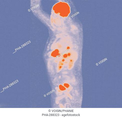 Positron emission tomography (PET) scans of a patient with a rectum cancer and hepatic metastasis