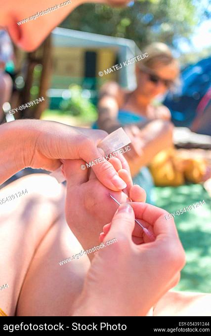 Woman taking spine out of her friends sole using medical needle after she stepped on sea urchin on summer vacations. Improvised domestic first aid