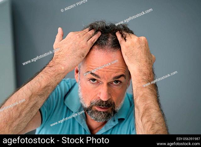Man Checking His Hair Loss And Dandruff