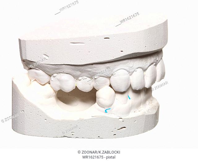 Dental gypsum model mould of teeth in plaster