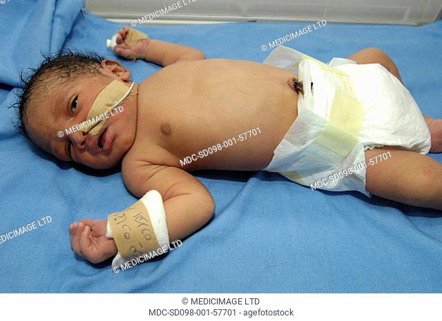 A premature baby with an intravenous drip sleeping in an incubator. The drip will allow doctors and nurses to feed the baby various drugs without the need to...
