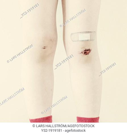 Closeup of the legs of a young child with bruises and bandaid