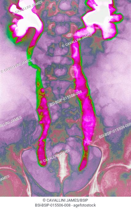 X-ray of urinary schistosomiasis. Frontal abdominal-pelvic x-ray