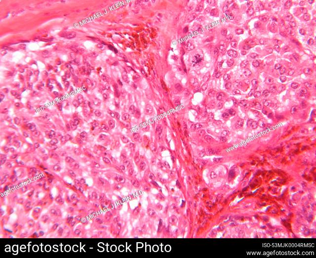 Microscope view of malignant melanoma