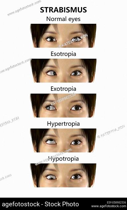 Strabismus surgery Stock Photos and Images | agefotostock