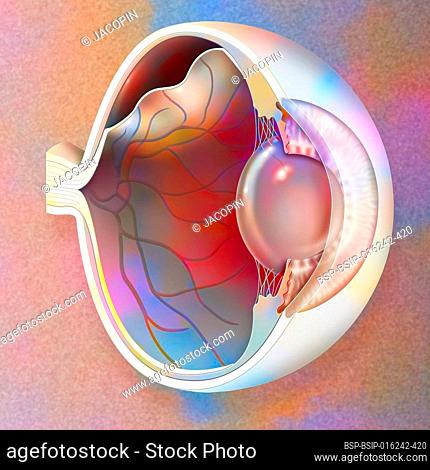 Eye: detachment of the retina, which detaches from the underlying choroid