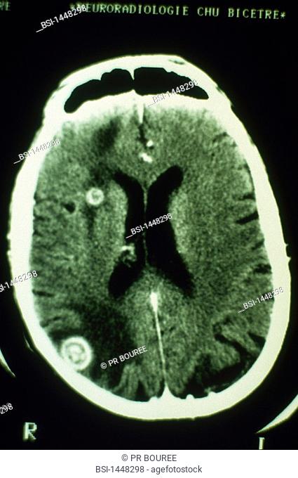 TOXOPLASMOSIS<BR>CT of brain
