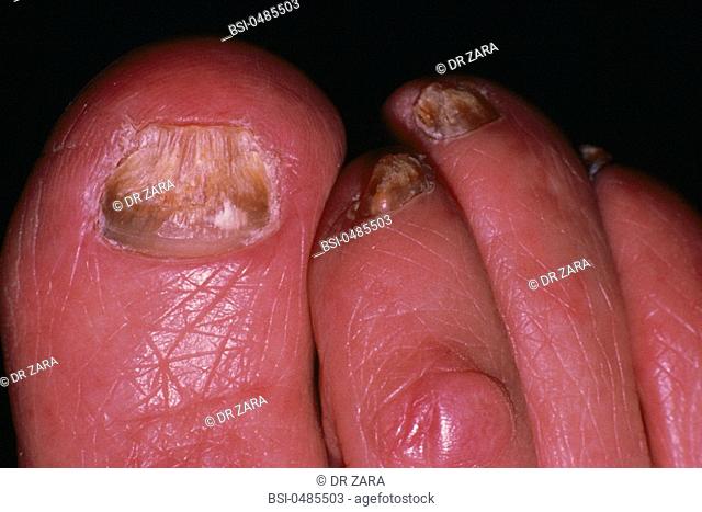 MYCOSIS<BR>Fungal nail infection caused by trichophyton rubrum