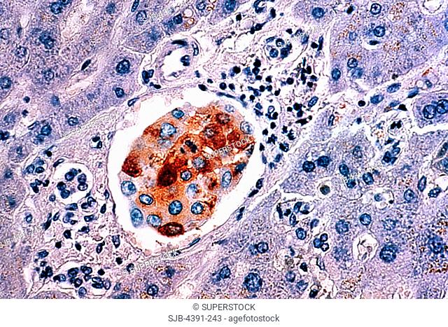 These malignant breast cancer cells have metastasized to the liver. A cluster of the cancer-cells with their brown-staining cytoplasm is pictured within a...