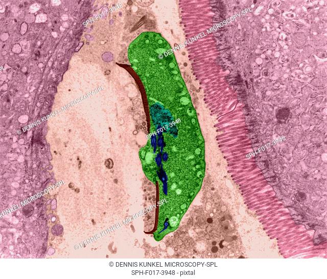 Protozoan infection (giardiasis) in human intestinal lumen (Giardia sp.), coloured transmission electron micrograph (TEM)
