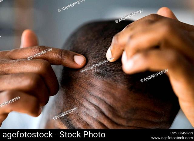 Young African Men Hair Loss. Watching Hairloss