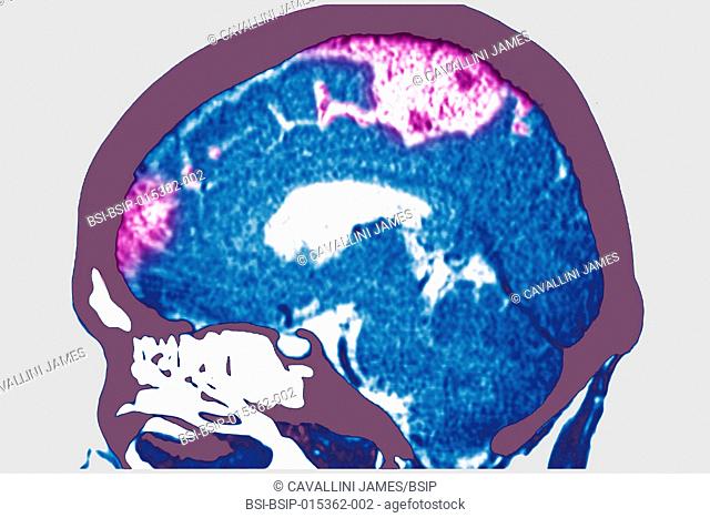 Cerebrovascular accident caused by thrombosis of an artery in the left hemisphere. Saggital plane cross-section brain scan