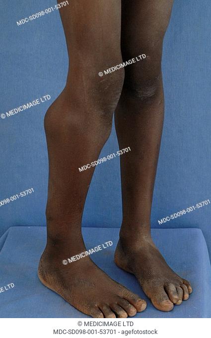 Multiple Fibromatosis is characterized by the formation of multiple noncancerous benign tumors