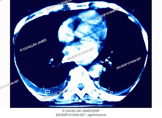 Asbestosis (pulmonary fibrosis) seen on an axial section chest scan
