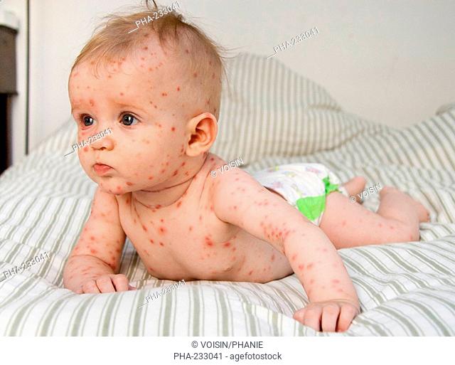 Chickenpox on a 4 months old baby