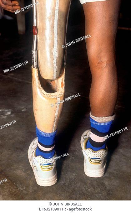 Man with artificial leg at the Apahaj Ashram, Patiala, Punjab, India