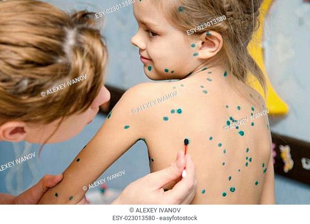 Little girl with chickenpox sores smeared zelenkoj