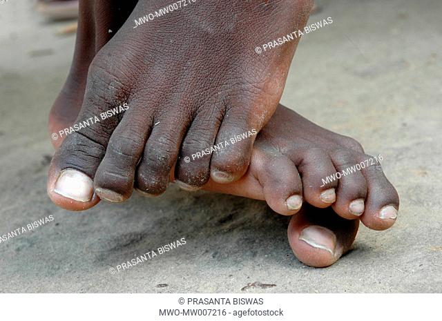 Mithun Patra, a physically and mentally disabled child trying to balance his body with this left toe Jaduguda, India March 11, 2007