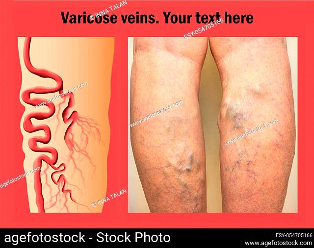 The varicose veins on a legs of old woman. Collage with copy space