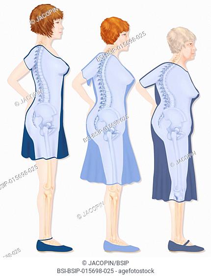 Illustration of the evolution of osetoporosis shown in the outline of a woman. On the left, a young woman with an upright posture