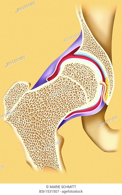 HIP, ILLUSTRATION Coxofemoral articulation and femur neck. See images 1531607 for the hip arthrosis, 1531707 for the osteoporosis and the fracture of the femur...