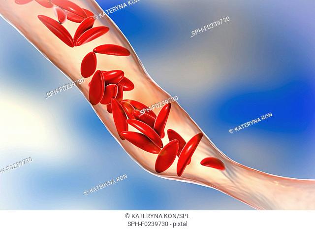 Sickle cell anaemia. Illustration showing red blood cells affected by sickle cell anaemia (crescent shaped). This is a disease in which the red blood cells...