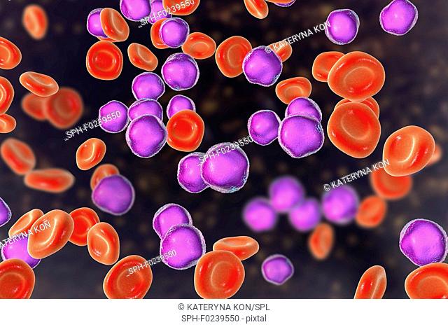 Acute lymphoblastic leukaemia bone marrow smear. Computer illustration showing abundant lymphoblast cells in human bone marrow