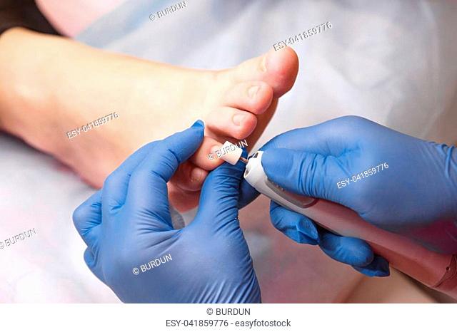 Podology treatment. Podiatrist treating toenail fungus. Doctor removes calluses, corns and treats ingrown nail. Hardware manicure. Health