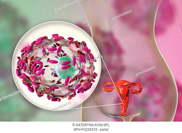 Bacterial vaginosis, illustration