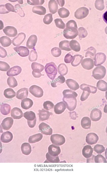 Red blood cells with anaemia