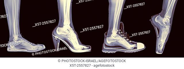 X-ray of a woman's foot in 4 different shoes (from left to right) Trainers, High Heel, Running and Ballet