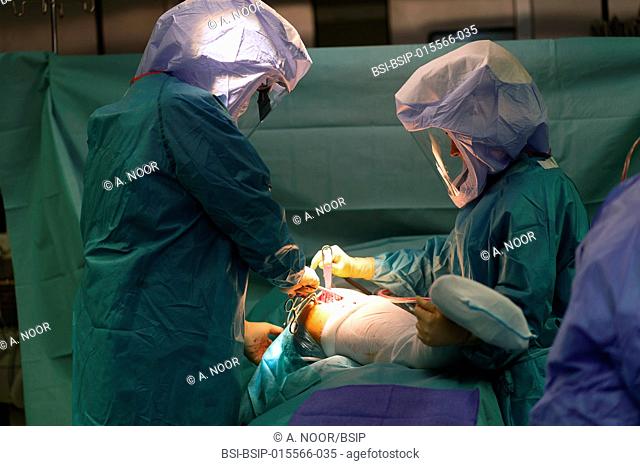 Reportage in the orthopedic surgery service in Saint George Clinic, Nice, France. Fitting a dual mobility hip prosthesis in a patient suffering from...