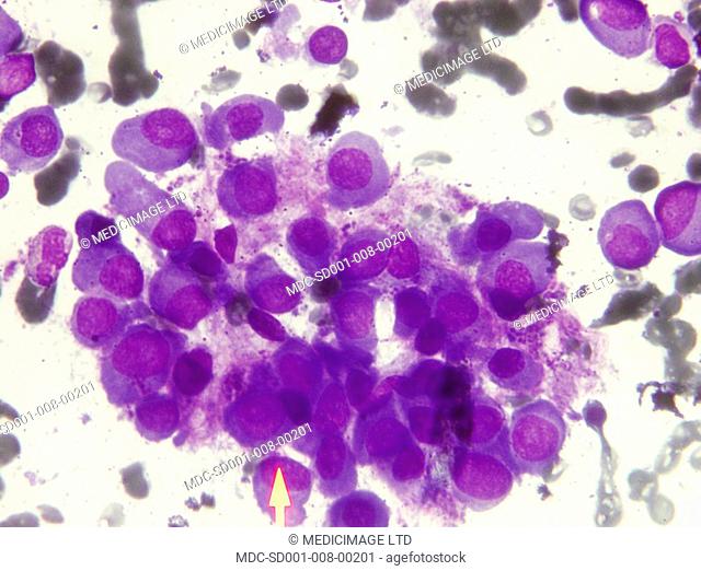 Microscopic image of Multiple Myeloma./n/nMultiple Myeloma is type of cancer which occurs when a plasma cell becomes abnormal and cancerous
