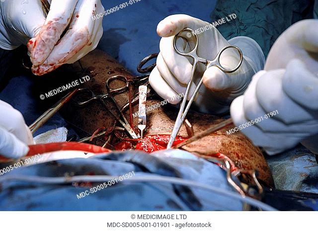 Close up of surgeons performing an axillary artery aneurysm repair on the arm of a teenage boy after a stab wound to the shoulder