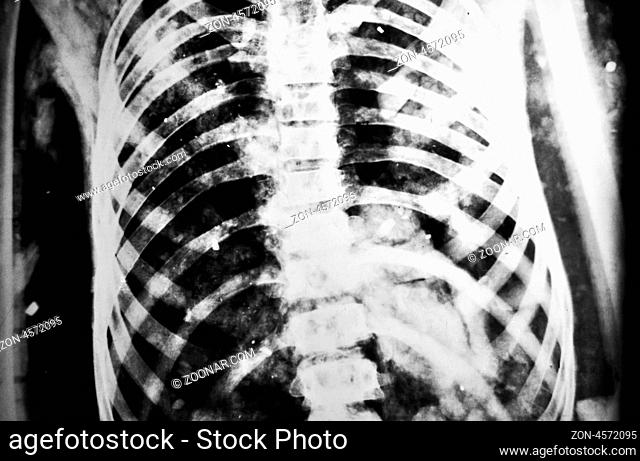 X-ray image of bones