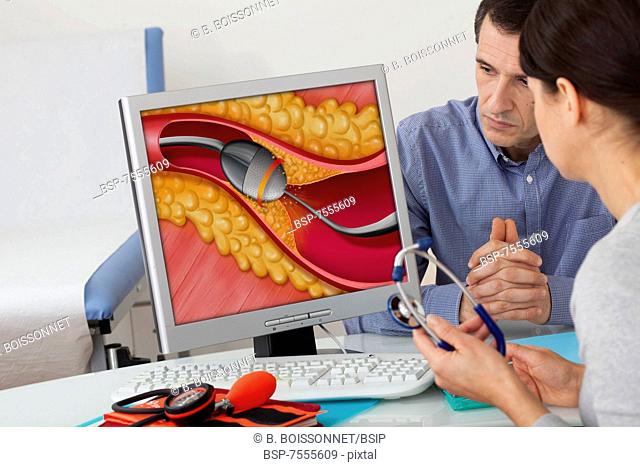 CARDIOLOGY CONSULTATION MAN Models. On screen, illustration of a rotational atherectomy by rotablator. Rotablator pulverizing the calcified plaque of atheroma