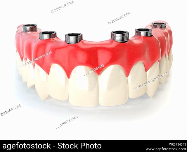Dental prothesis isolated on white. 3d illustration