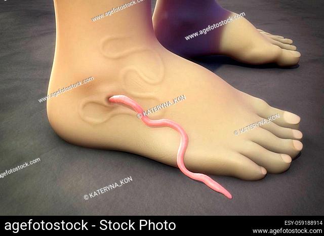Guinea worm disease, dracunculiasis, 3D illustration. A disease caused by nematode roundworm Dracunculus medinensis, it occurs by drinking unfiltered water...