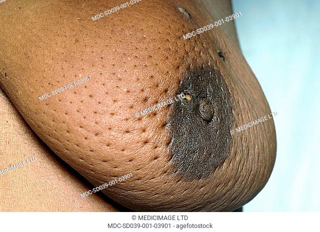 A woman with carcinoma of the left breast./n/nThe lymphatic system is responsible for drainage of the interstitial fluid lymph bathing the cells