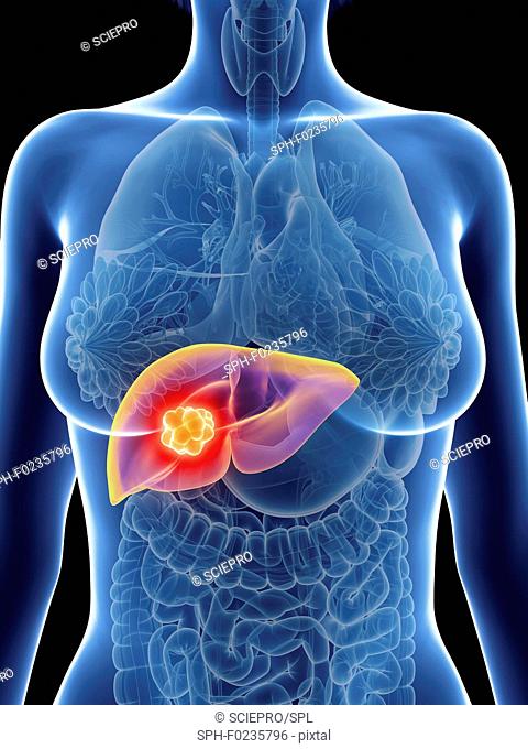 Illustration of a woman's liver cancer